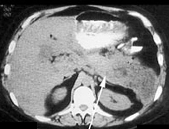 Abces pancreatic